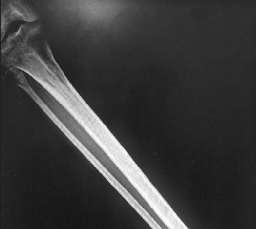 A seemingly normal radiograph of the knee joint and tibia anteroposterior view.